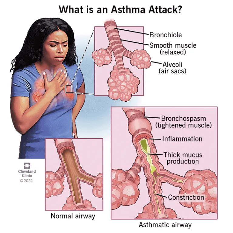 6424-asthma.png.webp