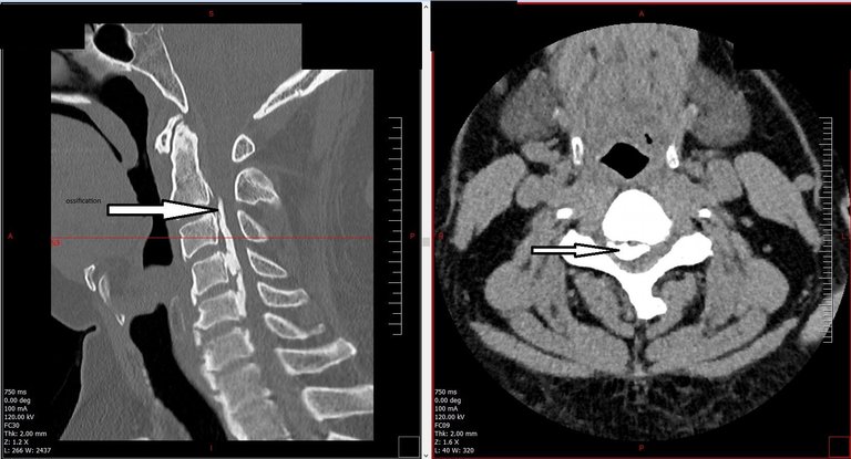 cervical_ct-c3_edit.jpg