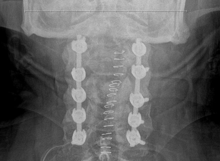 post_surgery_x-ray_backview.jpg