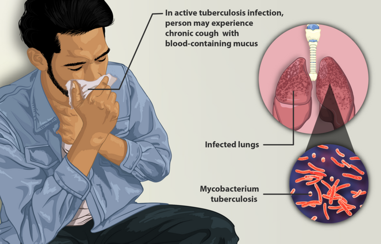 Depiction_of_a_tuberculosis_patient.png