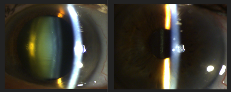 Cataract_Before_&_After_Cataract_Surgery.png