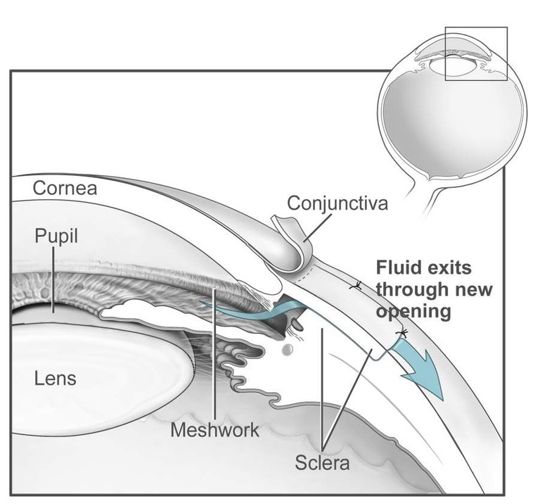 Conventional_surgery_to_treat_glaucoma_EDA11.jpeg