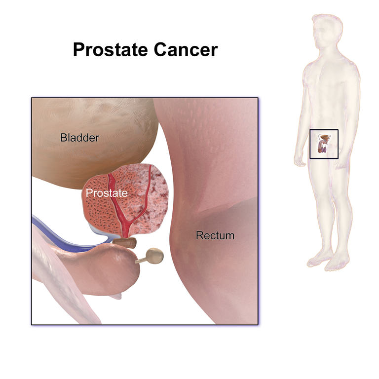 Prostate_Cancer.png