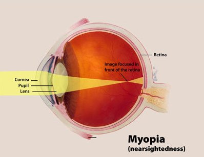 Myopia_Diagram.jpg