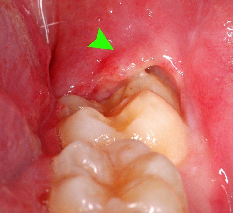 2000px-38_pericoronitis_with_pus.jpg