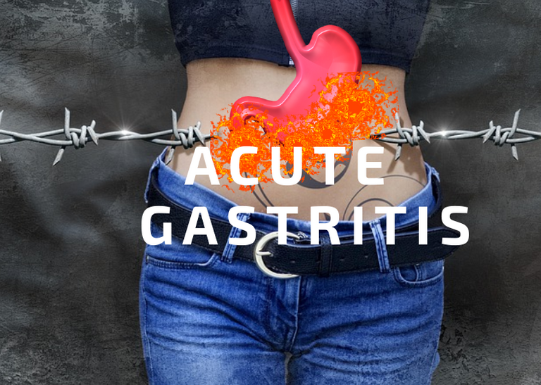 acute gastritis.png