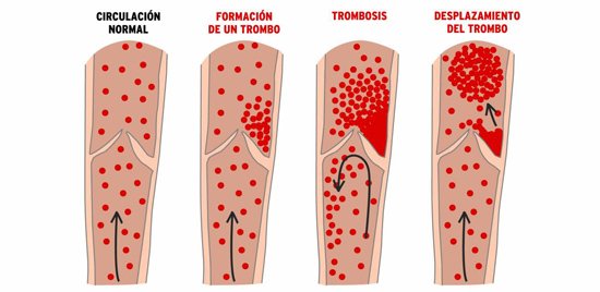 trombosis-1.jpg