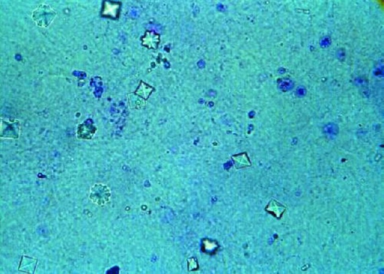 Calcium_oxalate_crystals_in_urine.jpg