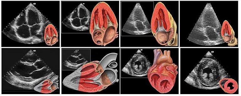 800px-Heart_normal_tte_views.jpg