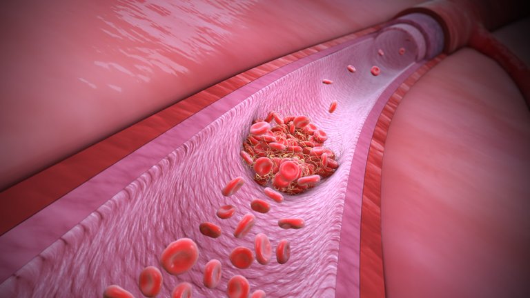 3D_Medical_Animation_Thrombophilia.jpg