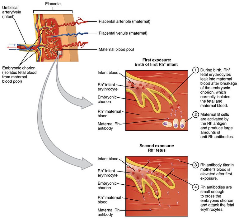 Erythroblastosis_Fetalis.jpg