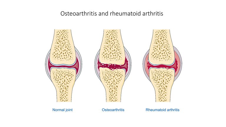 Osteoarthritis_and_rheumatoid_arthritis_-_Normal_joint_Osteoarthr_--_Smart-Servier.jpg