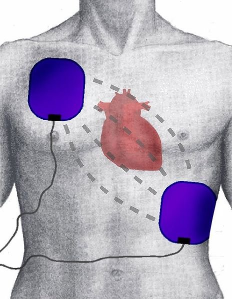 464px-Defibrillation_Electrode_Position.jpg