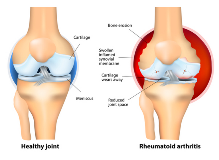 Rheumatoid-Arthritis (1).png