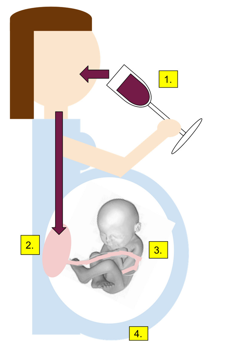 779px-Fetal_Alcohol_Syndrome.SVG.png