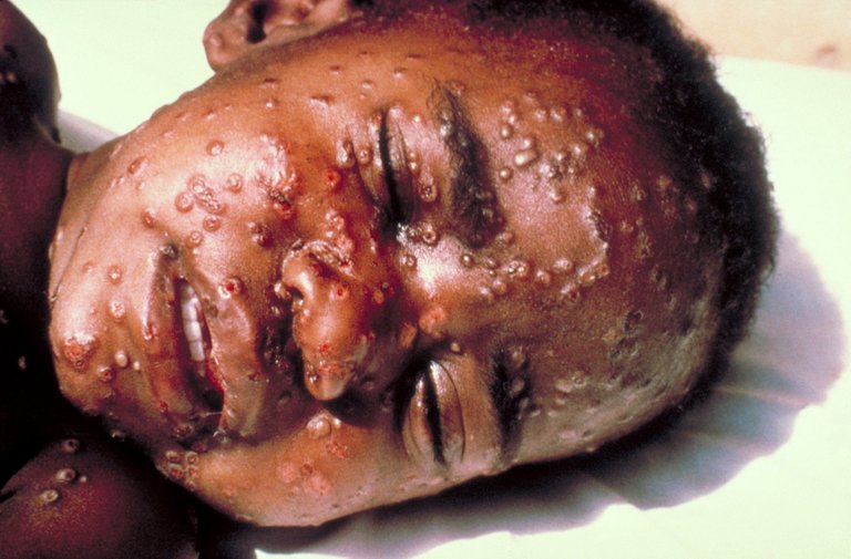 Smallpox.jpg