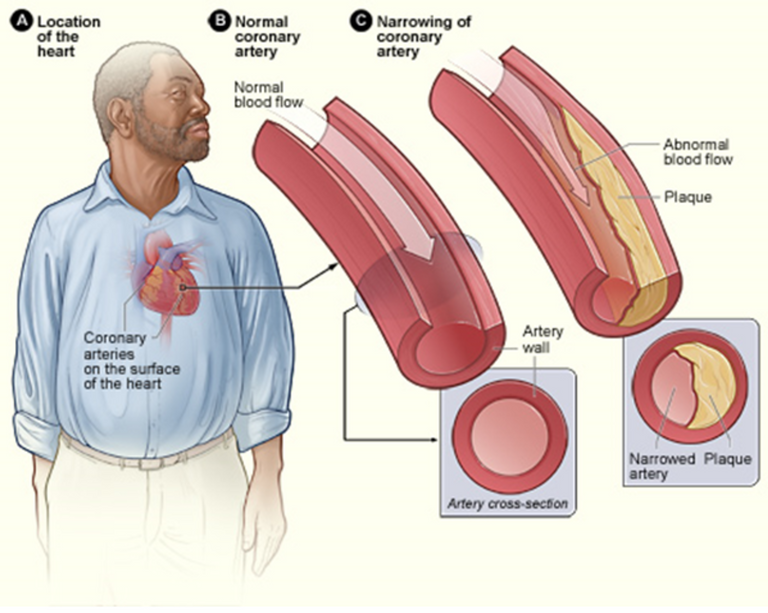 Coronary_heart_disease-atherosclerosis.PNG