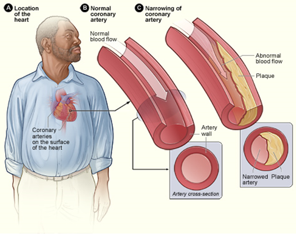 Coronary_heart_disease-atherosclerosis.png