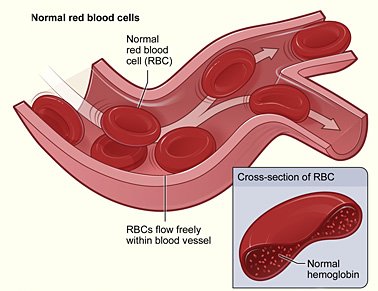 Modified_sickle_cell_01.jpg