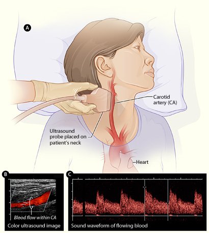 Carotid_ultrasound (1).jpg