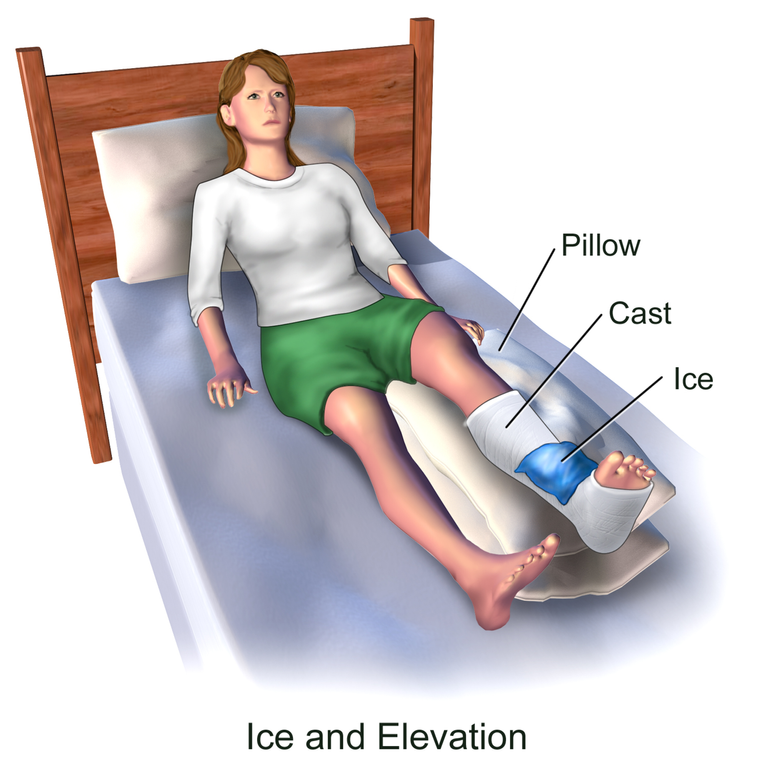 Ice_&_Elevate_Leg_Part_2.png