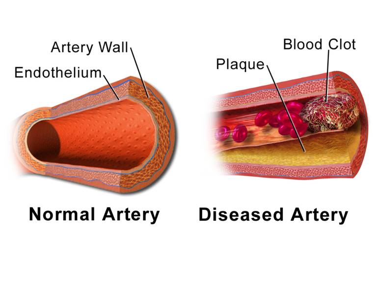 2000px-Blausen_0053_Artery_NormalvsDiseasedVessel.png