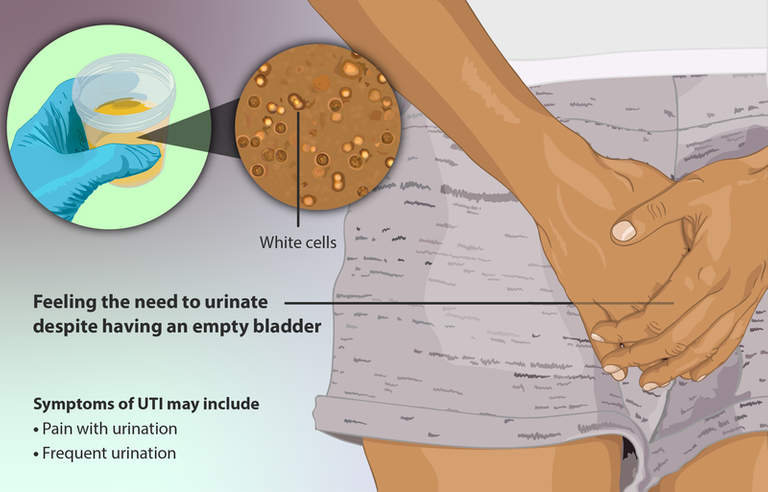 Depiction_of_a_lady_who_has_a_Urinary_Tract_Infection_(UTI).png