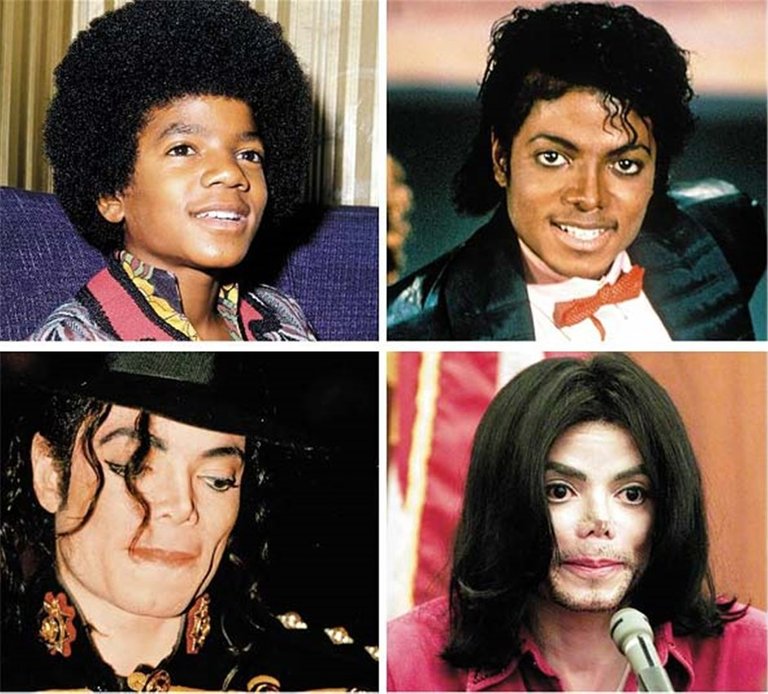 Immer-wieder-Operationen-Michael-Jackson-19731983-oben-162114h.jpg