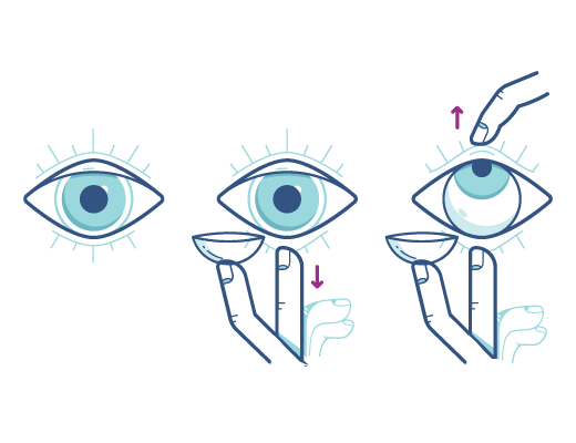 Acuvue_eyeopeningtechnique_Illustration.png