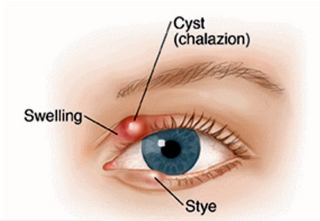 Stye illustration.jpg