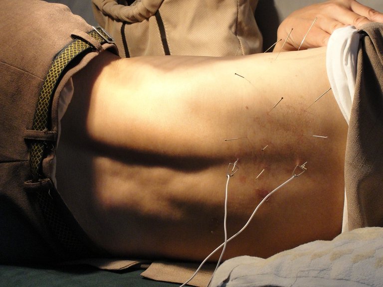 acupuncture3275458_1280.jpg