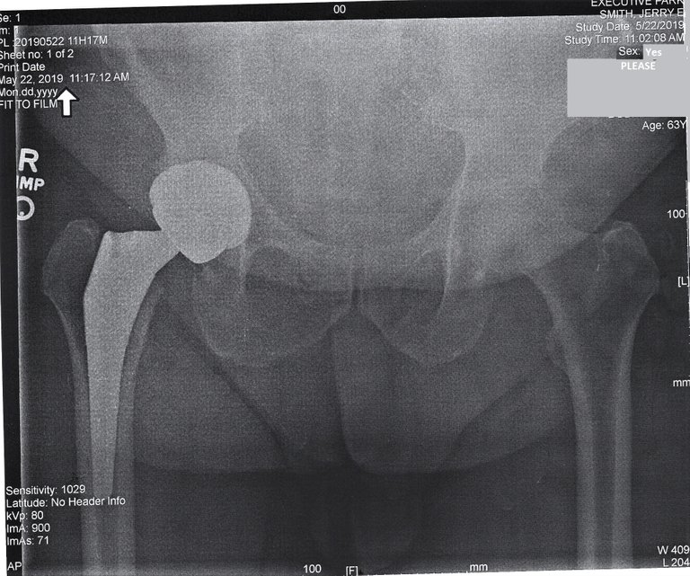 New Hip 1_cleaned.jpg