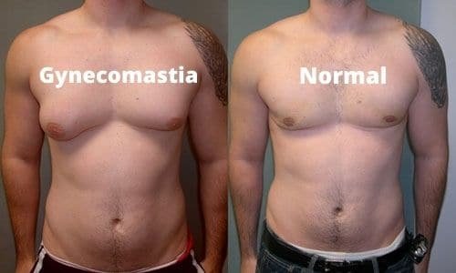 Gynecomastia.jpg