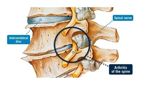 Arthritic spine.jpg