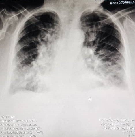 Radiografía de Tórax de la Paciente