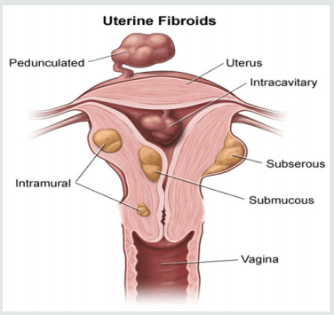 uterus.png