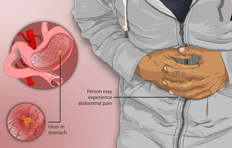 1280px-Depiction_of_a_patient_suffering_from_peptic_ulcers.png