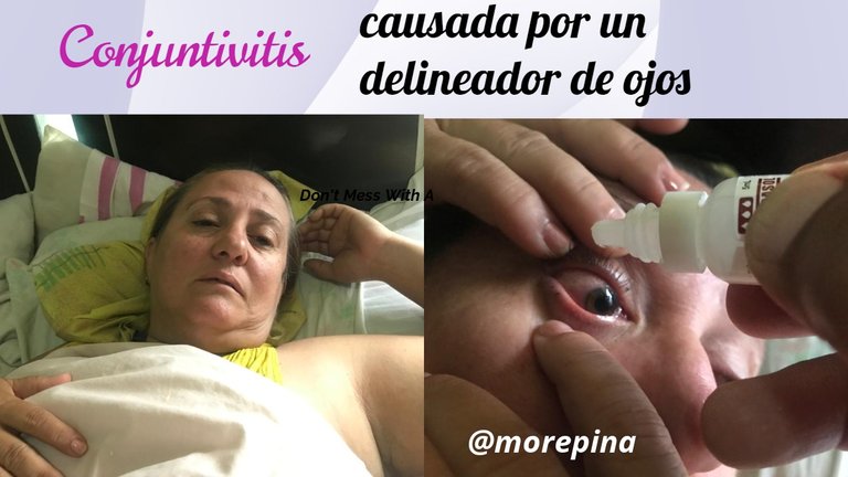 conjuntivitis-causada-por-un-delineador-de.jpeg