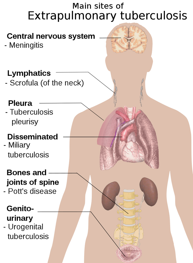 Extrapulmonary_tuberculosis_symptoms.svg.png