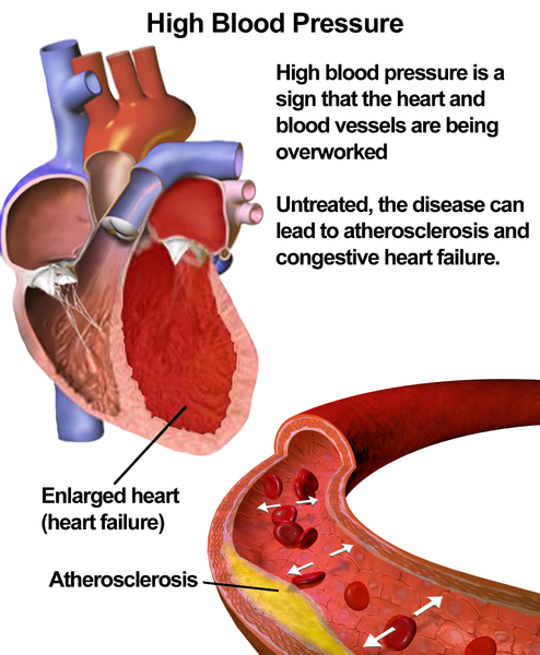 Blausen_0486_HighBloodPressure_01.png