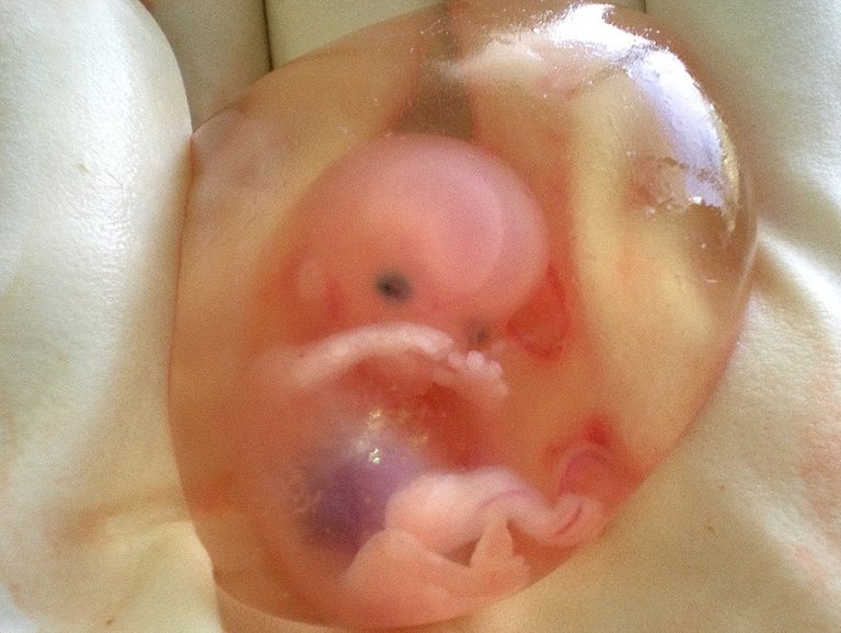 Human_fetus_10_weeks_with_amniotic_sac_-_therapeutic_abortion.jpg