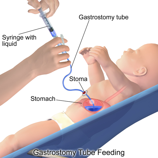 Gastric_Feeding_Tube_Infant.png