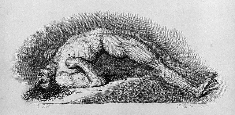 Patient_in_a_convulsion,_1847_Wellcome_L0005236.jpg