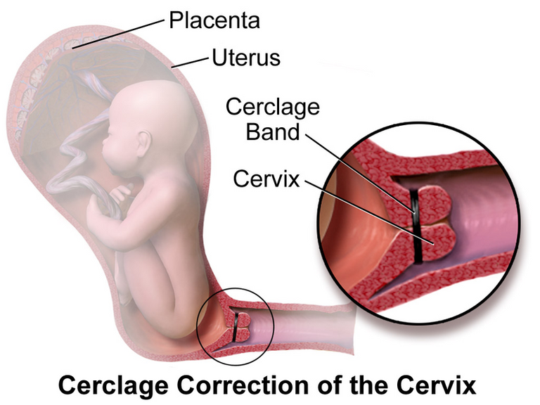 Cervical_Cerclage.png