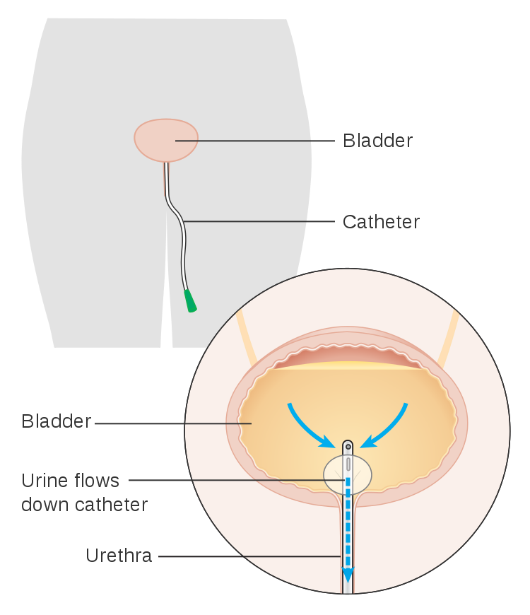 Diagram_showing_a_urinary_catheter_in_a_woman_CRUK_085.svg.png