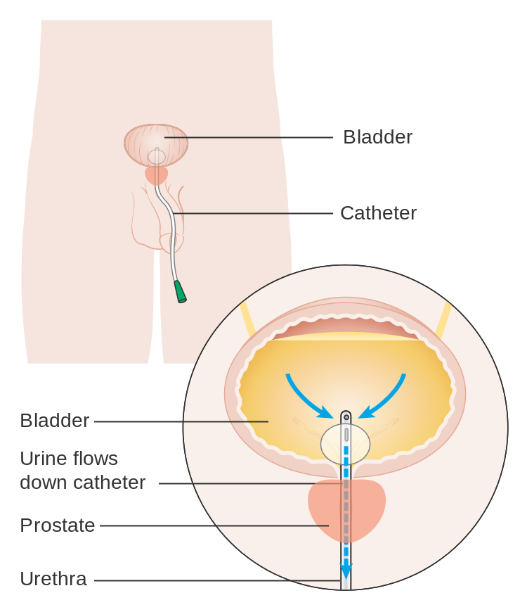 Diagram_showing_a_urinary_catheter_in_a_man_CRUK_084.svg.png