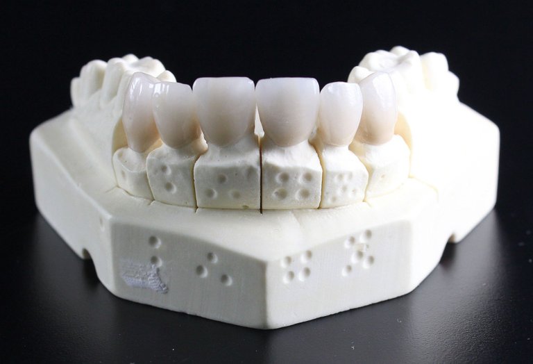 dentures-ga36262cf4_1920.jpg