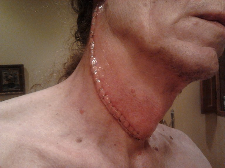 neck-staples.jpg