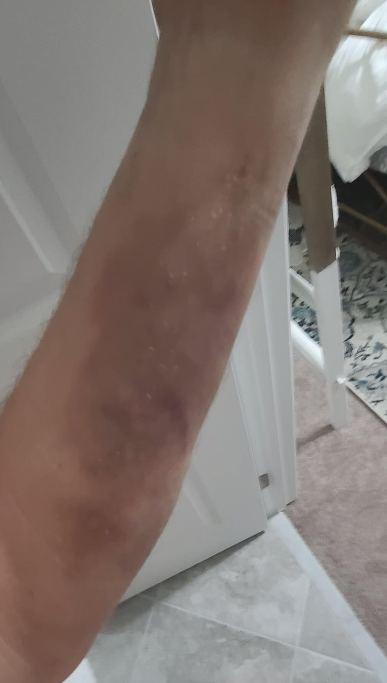 My left arm, bruised from trying to catch my weight as the ladder fell