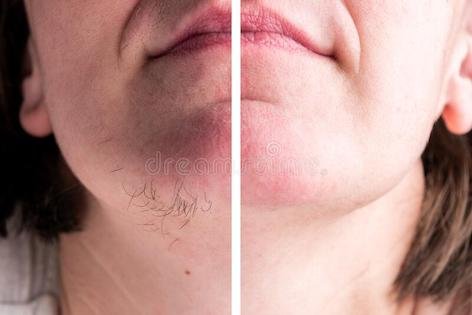hairs-chin-hair-removal-face-woman-173193850.jpg